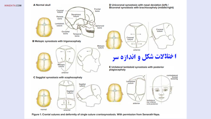 www.ninidata.com | اختلالات شکل و اندازه سر