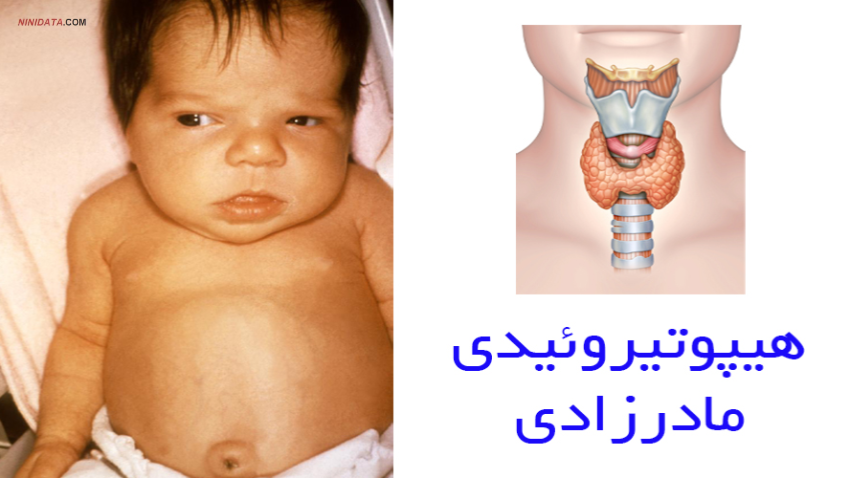 www.ninidata.com | هیپوتیروئیدی مادرزادی تیرویید (دانلود دستورالعمل پزشکان)