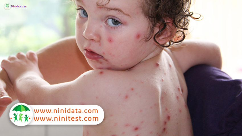 www.ninidata.com | آبله مرغان: علائم، درمان، روش های مراقبت و بهترین پزشکان شیراز