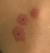 مایکو پلاسما پوستی 